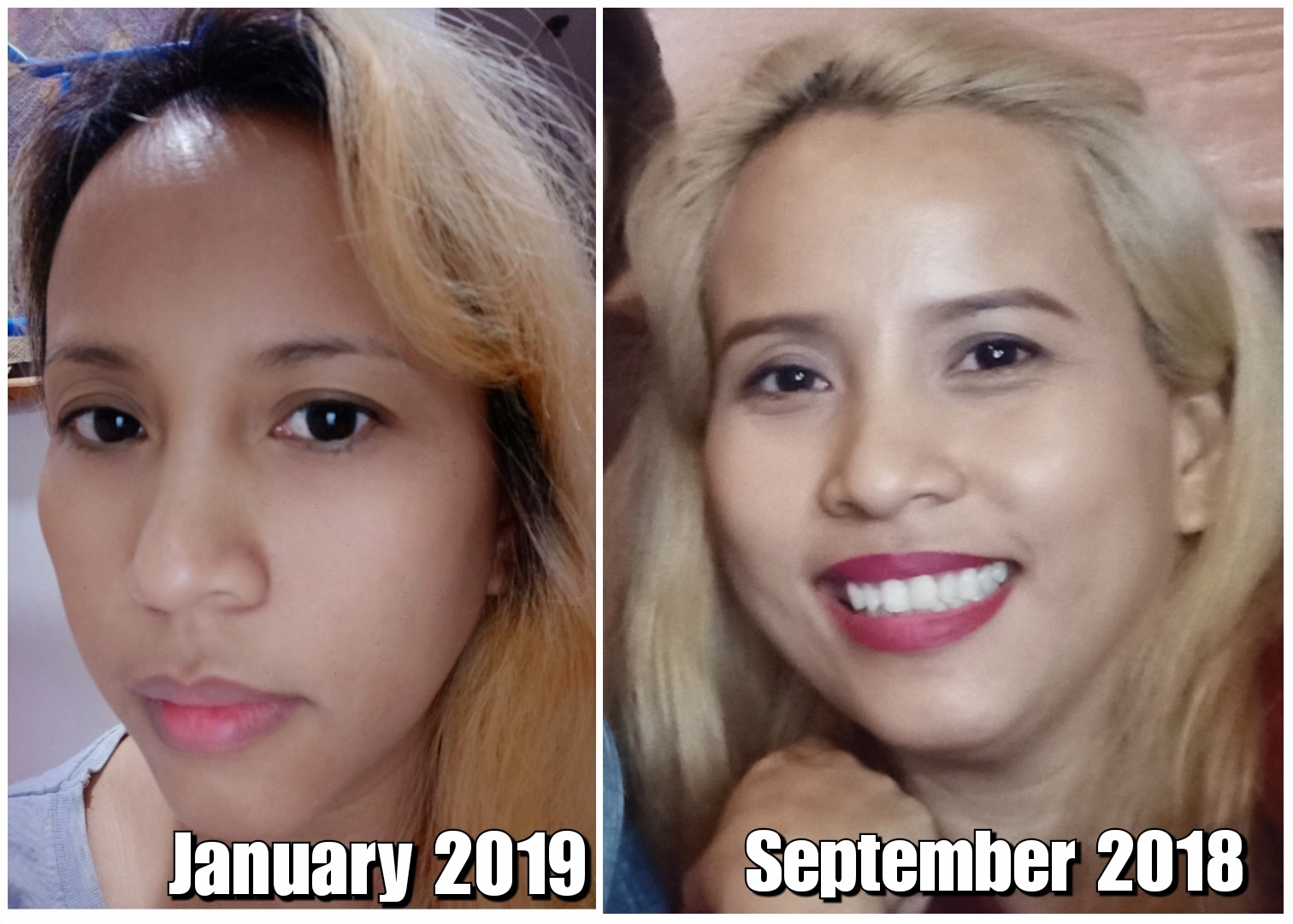 Biotulin Treatment conclusion